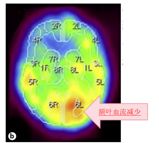 图2：右侧额叶明显脑血流减少、代谢低，提示既往脑梗病史。