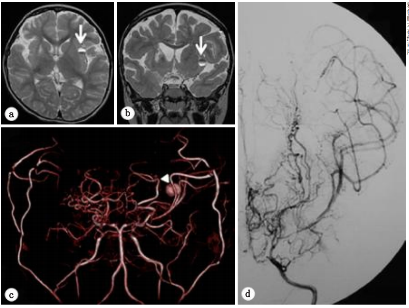 图4：轴向(a)和冠状(b)T2加权MRI显示左侧岛叶皮质有一个小的圆形混合强度质量（箭头）。（c）体积渲染磁共振血管造影，在大脑中动脉的左远端（箭头）发现一个浆果状病变，疑似大动脉瘤。（d）数字减影血管造影，左侧颈内动脉造影术未发现动脉瘤等异常表现。