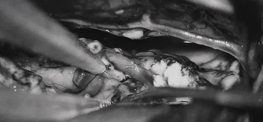 双额开颅，打开纵裂(鼻朝右，中线水平位，重力牵拉右侧半球)，显露胼胝体、CmaA和PcaA。切开胼胝体2.5cm，显露透明隔内的AVM，大致显露ACA。