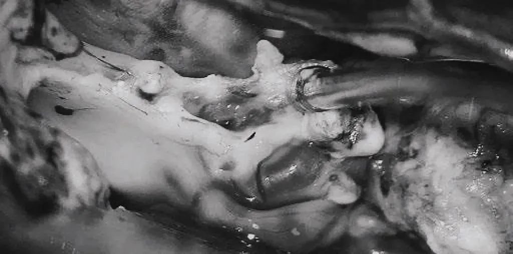 将AVM后缘向前牵离穹窿。