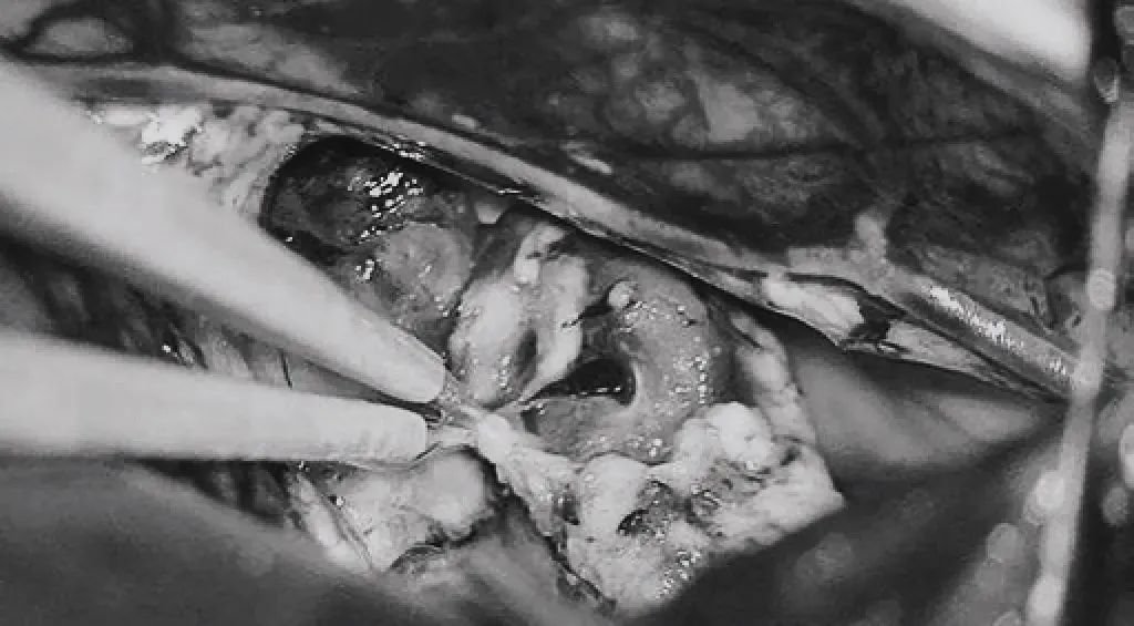 引流静脉进入ICV处电凝。完全切除AVM。