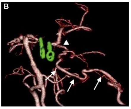 术后3D CTA显示左侧 PCA 区血管穿支(箭头)和重建的PTA血管(箭头)的血流通畅。