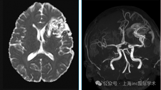 脑动静脉畸形是怎么一回事儿呢？ 简单来说就是我们的脑子里有动脉和静脉，好比城市里的道路，正常情况下，二者之间的“乘客”也就是血液，是通过毛细血管网进行“换乘”。 而脑动静脉畸形患者的毛细血管网可能由于先天性原因没有形成，动脉血就像失控的高压水枪一样冲进静脉，静脉因压力增大而扩张，动脉因供血增多而变粗，又有侧支血管的形成和扩大，逐渐形成迂曲缠绕、粗细不等的畸形血管团。 这些畸形血管比起正常血管要薄弱得多，就容易发生破裂出血。这种先天性疾病虽罕见，但一旦“引爆”，可能导致脑出血、癫痫甚至瘫痪。  得了脑动静脉畸形都有什么症状做什么检查才能发现它？   脑动静脉畸形(arteriovenous malformation, AVM)是最危险的脑血管畸形，可能引起很多患者颅内出血和癫痫。  常见症状  突发头痛：头痛难忍，休息之后，常伴随喷射状呕吐、意识模糊，这往往是血管破裂的警报。反复发作的癫痫：这种癫痫可能发生在出血前或出血后。持续性神经功能障碍：突然出现肢体麻木、说话含糊、视力模糊甚至偏瘫等症状。  无症状≠安全  多数患者早期毫无症状，直到体检或突发头痛、癫痫才被发现。也有的无症状的AVM可能永远不会引起问题，但无症状≠安全，因此发现它们后的管理和治疗决策需要仔细考虑患者的具体情况和出血风险。  出血风险：在一项系统评价中，未破裂AVM的年出血率为2.2%(95%CI 1.7%-2.7%)，破裂AVM的年出血率为4.5%(95%CI 3.7%-5.5%)。在使用个体患者数据水平的meta分析中，未破裂和破裂AVM的年出血率分别为1.3%和4.8%。 *阅读原文：无症状就不用治疗了吗？来探索脑动静脉畸形的治疗真相！   做什么检查才能发现它？ 如果出现癫痫或者头痛等症状，可做相关检查。对于病因不明的颅内出血、新发癫痫发作、急性神经功能障碍或神志改变患者，应考虑脑AVM。   1 初筛利器：磁共振（MRI）像给大脑拍"高清写真"，能够清楚地显示动静脉分流和病灶周围脑实质的结构。MRA 上可以看到不同程度扩张的供血动脉，有时可以在供血动脉上发现动脉瘤的存在。同时 MRI 也是发现既往出血的方法。  2 金标准检查：脑血管造影（DSA）为AVM血管形态的分析，可以明确供血动脉的数量和来源，以及发现血流相关性动脉瘤。  3 急救CT：快速定位出血点突发头痛时，10分钟内的CT平扫就能判断是否脑出血，为抢救争取黄金时间。   采用什么样的治疗手段是最优解？   根据美国一项脑AVM研究数据，AVM出血几率为每年1%-3%，与每次出血相关的死亡风险为10％至15％。永久性脑损伤的几率为20％至30％。每当血液渗入大脑，正常的脑组织就会受损，这导致正常功能丧失。超过50％的脑AVM患者有颅内出血。在脑AVM患者中，20％至25％患有局灶性或全身性癫痫发作。  畸形血管团小的直径不到1CM，大的可达10CM，周围全是脑组织，而这个畸形的血管团可随人体发育而增长，因此，早发现早治疗至关重要，以免爆发颅内出血这些“惊险时刻”。   A 已破裂的脑动静脉畸形 显微手术开放性显微外科切除用于特定AVM患者的根治性治疗历史最长，对于高出血风险患者，立即治愈的几率也最大。此类手术复杂，通常需要分析影像学检查结果并制定详细的治疗计划。相比其他介入治疗措施(放射外科和血管腔内栓塞)，显微外科切除的主要优势包括完全闭塞病灶的成功率很高、立即消除出血风险以及疗效长期性。 血管栓塞血管内介入治疗动静脉畸形对婴幼儿意义重大。这些人群因动静脉瘘，严重的循环障碍及进展性脑缺血发作，需要急诊干预。对于儿童和青年患者，血管内介入常作为显微手术的辅助治疗方法，因为这部分人群常发生出血，需要手术切除的同时清除血肿。术前栓塞的目的在于闭塞出血源，减少供血动脉的血流。只有很少的患者，可以通过血管介入治愈。 放射治疗立体定向放射外科治疗也是一种治疗手段，其风险主要在于达到最大闭塞程度前存在较长的潜伏期；另外邻近的正常脑组织功能常受影响。立体定向放射成功闭塞畸形血管依赖于准确的确认动静脉分流部位。其并发症也主要与放射剂量有关。动静脉畸形的血流量也能影响闭塞的效果。因此，治疗时需要权衡效果与风险。  B 未破裂的脑动静脉畸形 对于大多数AVM破裂的患者，适用于介入治疗。AVM介入治疗适用于大多数并发急性颅内出血患者或成像检查显示有陈旧性颅内出血的患者，尤其是存在支持治疗的其他危险因素时，如病灶位置较深或仅有深静脉引流。内科保守治疗可能适用于没有其他危险因素的老年患者或手术风险太高的患者。  C 无症状的脑动静脉畸形 对于无症状的AVM患者，治疗需求取决于出血风险评估。高风险患者需要干预治疗以预防未来并发症，而低风险患者则可以选择观察和定期检查。     关于手术风险 AVM的手术风险：包括但不限于，手术中的操作失误会造成神经功能损伤，可能导致语言或视觉障碍；同时会伴有出血风险。因为人脑的精密程度极高，所以神经外科手术又需要经验及其丰富的<a href='/jiaoshou/' target='_blank'><u>神经外科专家</u></a>来操作。 术后并发症：也可能包括持续的头痛或神经痛；操作区域出血或肿胀；长期的神经功能障碍。 此时，找到一位经验丰富并且有强理论支撑的医生进行手术治疗是有效避免手术风险以及术后并发症的保障。