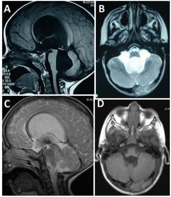 合并小脑功能异常共济失调的3岁大的小男孩进行内镜下第三脑室造瘘术，成功控制了脑积水的产生，手术过后小男孩症状迅速消退，预后效果非常好。