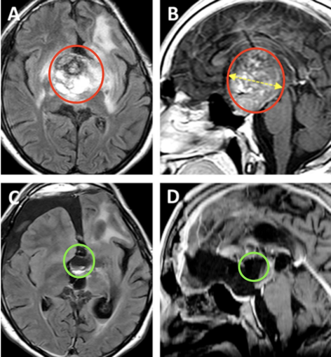 术后MR提示肿瘤近全切除，从而使患儿的视交叉和视神经束、垂体柄和下丘脑保持原样，极大保障了孩子之后的生活质量。