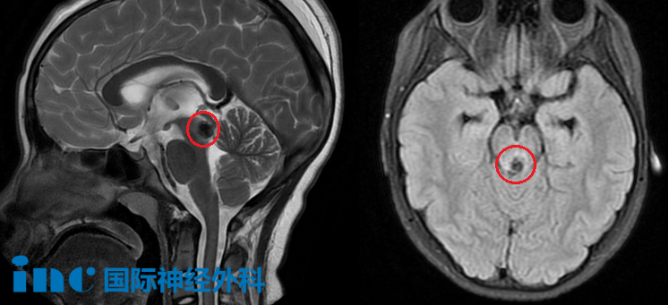 ＂11岁女儿脑干出血！立即手术还是保守观察？全切后还会复发吗？＂