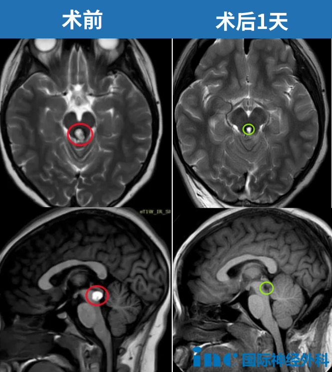 2024年8月5日，湘湘的手术在苏州大学附属儿童医院顺利开展，术后核磁显示，病灶全部切除。