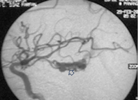 图(a)左侧 ICA 造影,侧位和 lPChA
