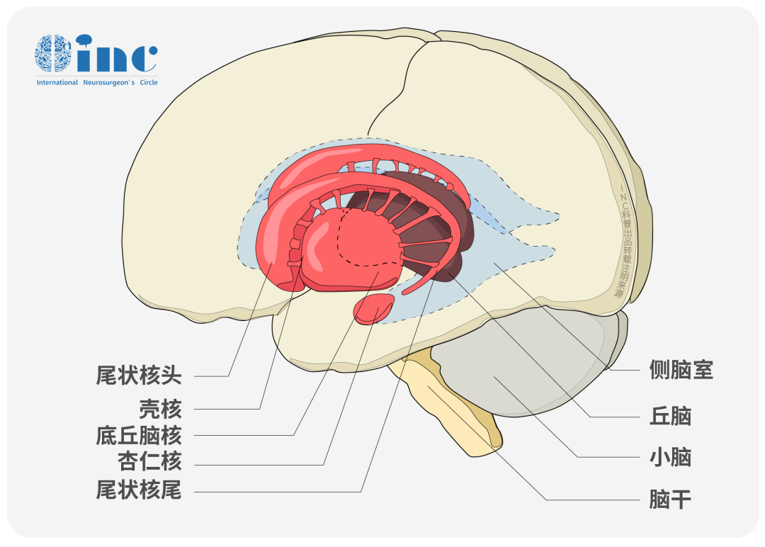 “罕见部位脑动静脉畸形”“首次术后没切干净”“术后3个月突发昏迷” 18岁的大卫在确诊颞角脑动静脉畸形后，这些轮番的打击，让他的世界一度陷入了灰暗。 但幸运之神总是会在关键时刻降临，多方查询后，大卫一家找到了国际脑动静脉畸形专家——INC美国Michael T. Lawton教授，了解到大卫的病史后，Lawton教授为大卫制定了手术方案，最终成功全切颞角AVM。  大卫 18岁罕见位置脑动静脉畸形病情阶段 18岁的大卫因为频繁头痛，去医院检查结果却确诊为脑动脉畸形。 这个病症除了让他会头痛以外，更令人担心的是随时可能发生的颅内出血。 治疗的棘手之处：大卫的脑动脉畸形位置特殊，位于颞角脉络丛，术中一旦出血，大卫很有可能会有生命危险。 颞角位于侧脑室，与丘脑、尾状核(尾部)、穹窿（伞）和海马相邻，其中，作为人体“感觉中转站”，身体的所有感觉信息都会在丘脑内转车，再投递到大脑皮质。丘脑不仅可以感知世界，还在运动、语言等方面发挥重要作用。 首次手术术后三月突发昏迷 考虑到需要尽快排除脑子里的“不定时炸弹”，于是，大卫的父母带他来到医院进行手术。 然而这次手术却未能将颞角脑动静脉畸形完全切除。  首次手术仅仅三个月后，大卫在学校突然昏迷，紧急送往医院后，检查为左侧颞角的脑动静脉畸形导致脑室内出血（图a、b）。 Spetzler-Martin分级4级：S1V1E1/A1B0C0，供血来自AChA（脉络膜前动脉）。 图(a)左侧 ICA 造影,侧位和 lPChA  图(b)左侧 VA 造影，前后位像 * Spetzler-Martin分级：根据AVM大小、是否在功能区、有无深部静脉引流三项得分相加，评分范围为1~5，分别对应Ⅰ~Ⅴ级，分级越高，外科手术难度越大，预后越差。 第二次手术Lawton教授为大卫安全全切 大卫的分级为4级，手术难度非常大。所以必须找到经验丰富的医生来做这场手术，尽快解决问题。多方查询后，大卫一家找到了国际脑动静脉畸形专家——INC美国Michael T. Lawton教授。 了解到大卫的病史后，Lawton教授为大卫制定了手术方案，最终成功全切颞角动静脉畸形。 Lawton教授术中操作 左侧翼点开颅，再次手术，显露前颞叶。 沿颞下回经原皮层入路达颞角。AChA经脉络裂进入颞角，在前方供应AVM，lPChA在后方供应AVM。 通过ITG经皮层显露可以充分显露颞角，达到全切AVM。向左滑动查看  INC脑血管大咖Lawton教授颞角AVM的切除策略   颞角AVM切除与像颞底AVM类似，颞部开颅（第1步）后，通过颞下回（ITG）经皮质入路。病人取仰卧位，头向侧方偏转90°，降低顶点以获得一朝向颞角的向上的角度。 以耳上为基底的马蹄形切口、颞部开颅。入路在颞下回下部，角度对着脑室，保持在Meyer’s环内的视放射之下。Meyer’s环从上面越过颞角（第2步）。 导航有助于确定该入路。一旦进入颞角，沿其轴纵向打开，以完整看到AVM。直到切除结束才能够看到下ChorV和BVR （第3步）。 在脉络裂近端丛点之后辨认AChA，在脉络裂远端病变之后可见lPChA供血（第4步）。 先阻断AChA供血血管（第5步）,但是另外的自脉络丛的供血血管在内侧缘，从近端向远端继续分开脉络裂阻断这些脉络丛供血血管。 需要向前用力，将一部分AVM移向外侧（第6步）。优先通过脉络丛和穹窿伞（伞带）之间的脉络膜，从下方打开脉络裂，避开上面的尾状核尾部和丘脑下部。 最后一步切除的是汇入BVR的引流静脉和残留的来自lPChA的供血血管（第7步）。 第1步：暴露AVM——头皮马蹄形切口，颞部开颅，通过颞下回经皮层入路，术中见AVM来自AChA和lPChA的动脉供血，静脉向内侧引流到BVR，以及邻近优势半球的海马。 第2步：通过ITG经皮质入路进入颞角。 第3步：辨认脉络丛和脑室的引流静(BVR直到后来才能看到)。 第4步：辨认前方脉络裂内的AChA。 第5步：从近端脉络裂阻断AChA的前内面。 第6步：沿脉络裂由近及远分离。 第7步：将AVM移出脉络裂，以切断lPChA供血，辨认环池内的BVR。  INC 国际脑血管专家Michael T. Lawton教授 INC国际 Michael T. Lawton 教授作为巴罗神经学研究所主席兼首席执行官，深耕于脑动静脉畸形的形成、遗传学特征和破裂的治疗，以及脑部血管瘤的血液动力学、破裂、数字建模等领域。他的临床研究包括血管瘤、动静脉畸形、颅内搭桥的微创治疗方法，以及微创治疗临床数据。 他发表了450多篇神经外科专业文章，撰写3部个人著作（动脉瘤手术治疗著作《七种脑动静脉畸形：切除原理和技巧》、《七种动脉瘤：夹闭术的原理和技巧》、《七种搭桥术：血运重建的原则和技术》），是70多本医学专业书籍的部分章节作者，获得近20项国际医学奖项，是600多个专业讲座及世界40多个神经外科机构的特邀教授。  神经外科经验：脑动静脉畸形：900例脑动脉瘤：4400余例海绵状血管畸形：1000余例