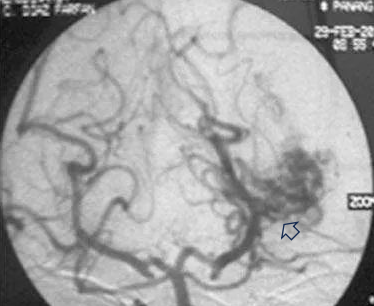 图(b)左侧 VA 造影，前后位像