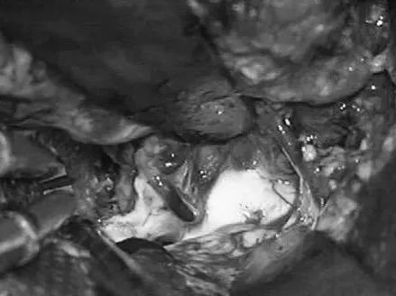 AChA经脉络裂进入颞角，在前方供应AVM，lPChA在后方供应AVM。