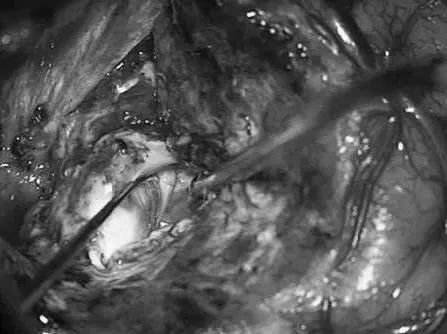 通过ITG经皮层显露可以充分显露颞角，达到全切AVM。