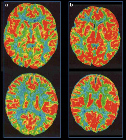 术前Xe-CT显示静息状态无偏侧(a)，注射丹木斯(Diamox)后右侧MCA区域脑血管反应性为14.8%(b)。