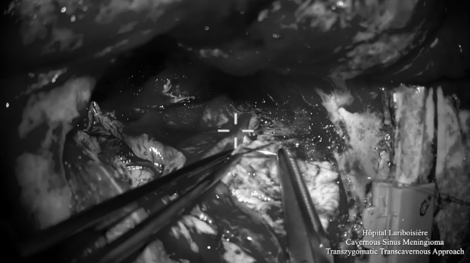 利用OPC间隙(orbitopterygopalatine corridor)进入蝶窦，发现肿瘤突出到窦内，暴露V2神经的侧面。神经内镜下对蝶窦中的肿瘤进行切除，这种方法可以切除硬膜内间隙和鼻窦中的肿瘤。为保留关键神经功能，海绵窦内的肿瘤没有切除。