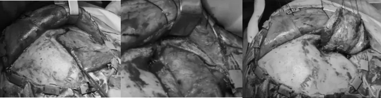 使用颧弓入路手术，利用筷子技术神经内镜+显微镜次全切除肿瘤，从海绵窦剥离硬脑膜，切除了浸润的硬脑膜和向颞部延伸的硬膜上脑膜瘤。