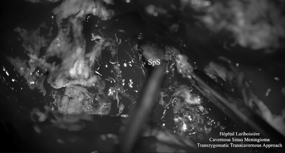 利用OPC间隙(orbitopterygopalatine corridor)进入蝶窦，发现肿瘤突出到窦内，暴露V2神经的侧面。神经内镜下对蝶窦中的肿瘤进行切除，这种方法可以切除硬膜内间隙和鼻窦中的肿瘤。为保留关键神经功能，海绵窦内的肿瘤没有切除。