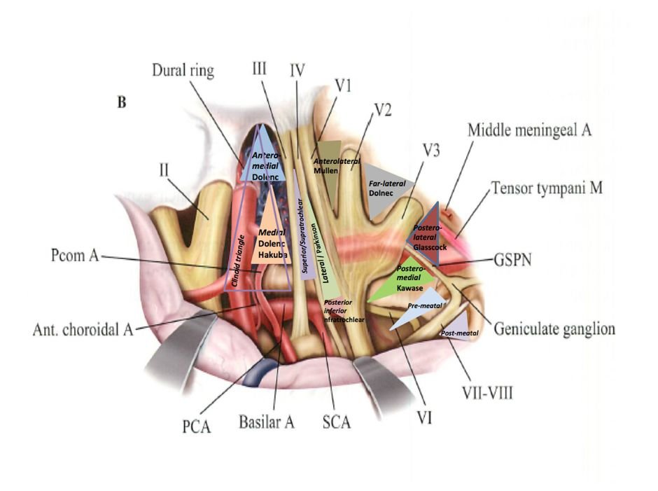 图：经硬膜外和硬膜内利用11个三角间隙充分显露的海绵窦，每个三角间隙可以作为安全进入海绵窦的手术路径（图Practical-Handbook-of-Neurosurgery-From-Leading-Neurosurgeons，改良后）。