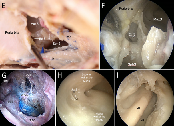经扩大的 AMT 开辟入路至蝶窦（SphS）