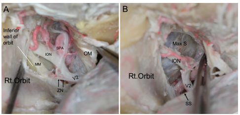 翼腭窝(PPF)的下移及眶翼腭走廊(OPC)的逐步暴露