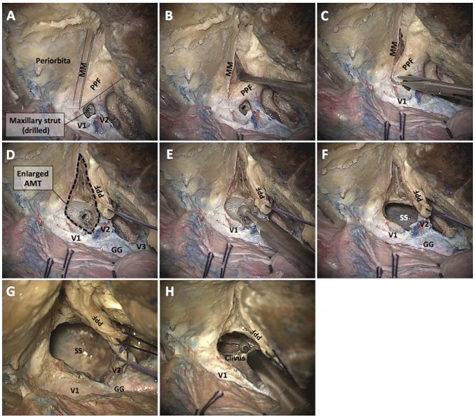 OPC的前部，暴露上颌窦(MaxS)