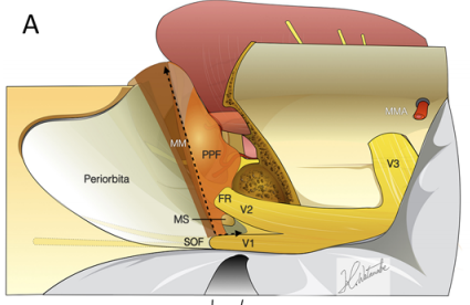 虚线表示筛骨水平(IOF)和颧弓(OM)的层面(MM)。MMA = 中脑膜动脉。