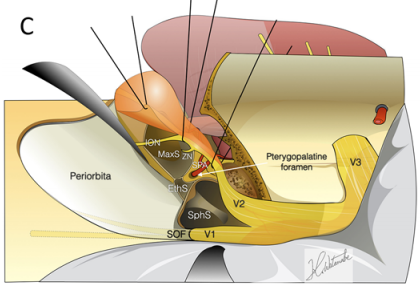 翼腭窝(PPF)和上颌神经的移位提供了进入蝶窦的显著通道。
