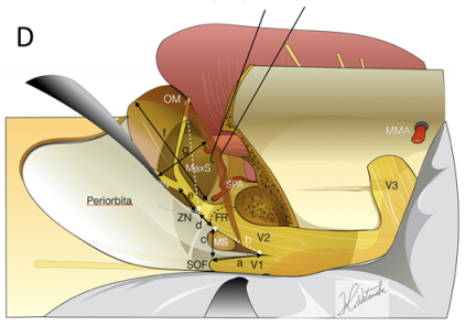 用于评估暴露程度的标志和测量。每个距离的测量如下：V1–V2角顶部与筛骨水平（SOF）之间的距离（a）；V1–V2角顶部与额突（FR）前端的距离（b）；SOF与FR之间的距离（c）；上颌支柱前缘与颧神经（ZN）之间的距离（d）；ZN与眶下神经之间的距离（e）；手术通道（OPC）的最大长度（f）；以及OPC的最大宽度（g）。