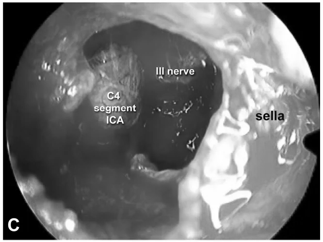 内镜下经内侧三角入路