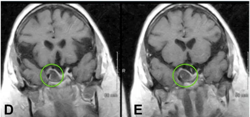三年随访，影像学检查未发现肿瘤复发或生长。