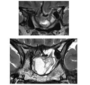 图：影像显示第一次肿瘤切除8年后复发，并伴有脑出血和鞍底下陷
