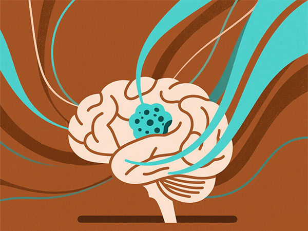 烟雾病病症怎么治？能手术吗？寿命多长？