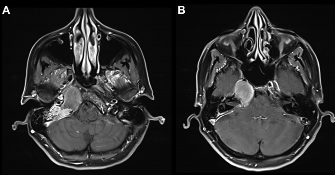 增强 MRI 显示病灶在岩尖、耳蜗和内听道侧面和后部出现均匀强化病灶， T2 低信号和 T1 高信号，病灶导致右侧内听道 ICA 和海绵窦向前移位。