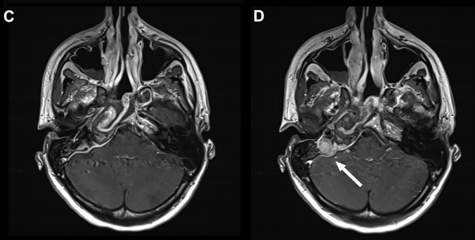 影像也显示，在岩尖区域难以到达的一个小角落，还残留了一小部分囊肿。这是为了最大程度保护周围极其重要的神经和血管结构而做的谨慎选择。