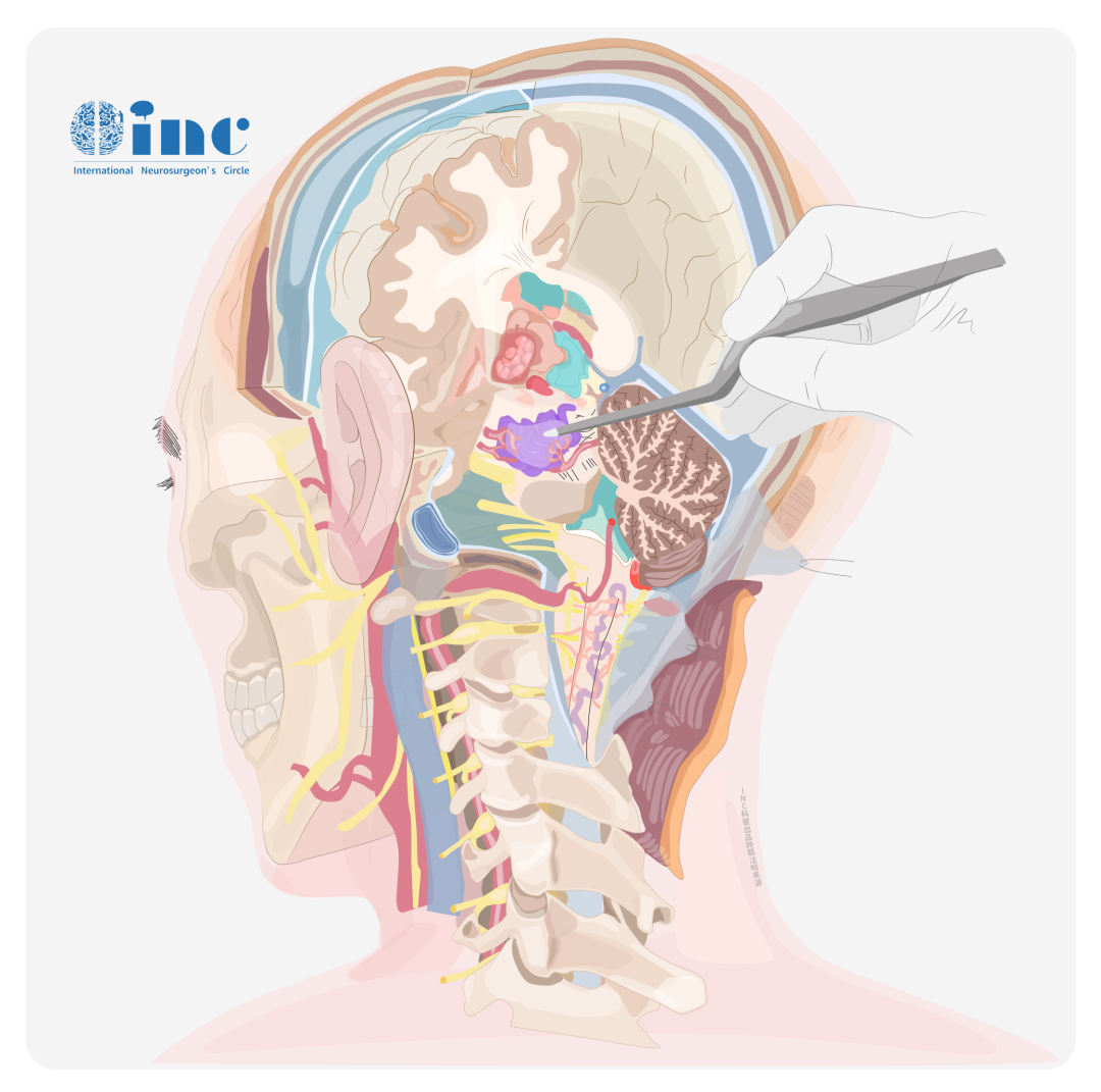 岩尖位于内耳前内侧，是颞骨岩段的内侧突出，作为颞骨的一部分位于颅底，呈金字塔形，可变充气结构，在舌骨上颈和颅内隔室之间形成了一个独特的交叉点。岩尖前表面形成中颅窝的后部，后表面形成后颅窝的前部。下表面形成了颅底的一部分。