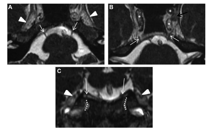 鉴于其位置，岩尖易受多种病理过程的影响，包括骨、气化空气细胞或岩颈内动脉的内在病变;侵入性“下行”颅内过程;或侵入性“上行”浸润鼻咽或鼻窦病变。
