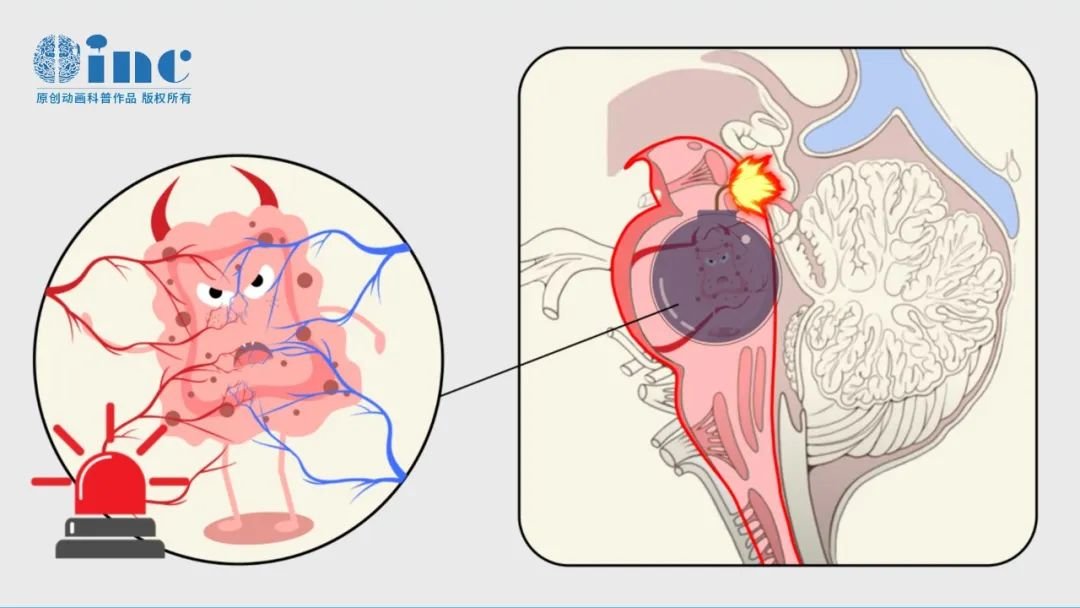 脑干CCM手术风险高、很难两全?