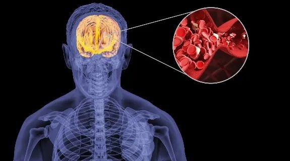 颈动脉在哪里？作为连接心脏与大脑的"生命高速公路"，颈动脉承担着向头部输送血液的重要使命。