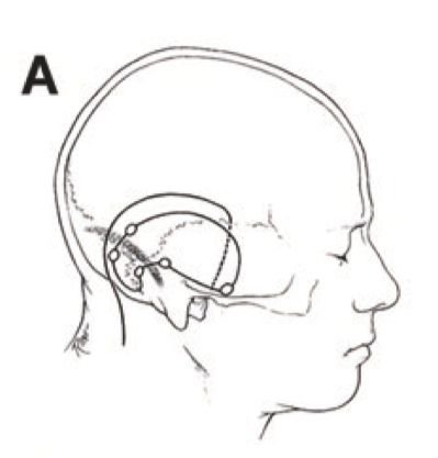 图A: 采用幕上-幕下联合入路，颞枕联合皮瓣，在颞部行低位颞部骨瓣开颅。