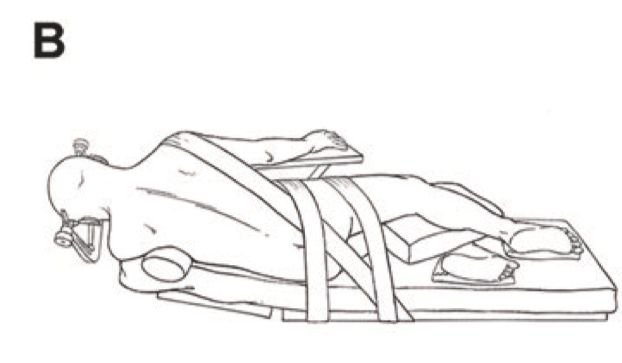 图B：病人采取侧卧位，应根据人体的四个生理弯曲及身体轴线，避免过度拉伸及屈曲，同时尽可能缓解压力集中的压迫点压力。