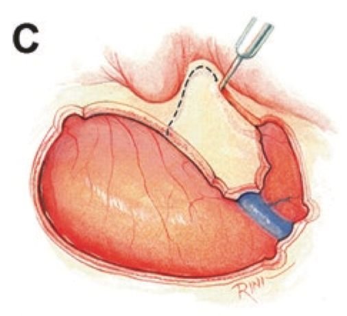 图C：切除在颞枕区域至枕下区域延伸的L形骨瓣后，沿着乳突周围外层开始逐步完成乳突切除术。骨瓣大小取决于听力状况和基础暴露的需要。