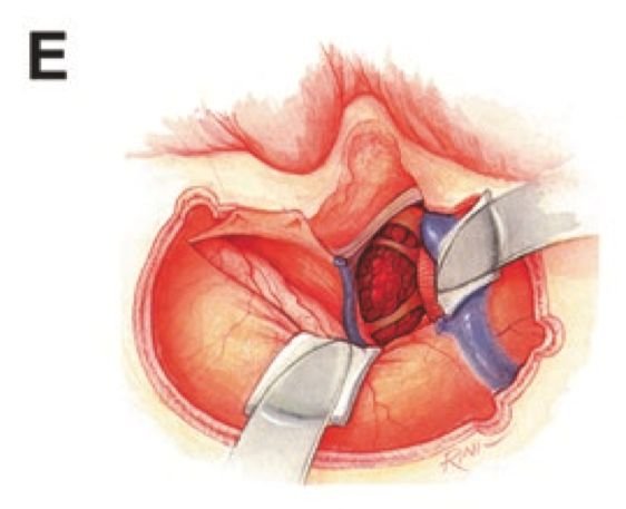图E: 打开硬膜，避免损伤横-乙状窦及Labbé静脉，该区域后颞叶的静脉引流存在变化(有时是多种多样的)，结扎上岩窦后，并确保颞叶的引流通畅，沿着岩骨尖分离天幕，定位并注意保护滑车神经等。