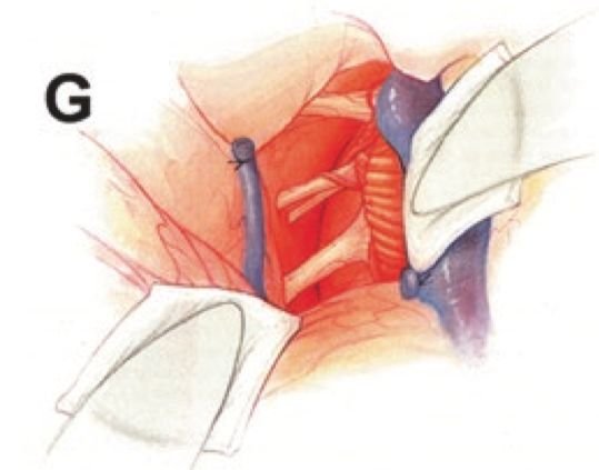 图G：肿瘤成功全切，神经组织保存完好。