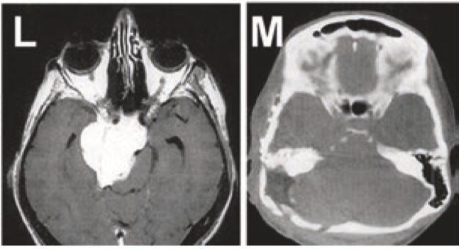 图L+M：岩斜区脑膜瘤患者，术前术后的影像对比