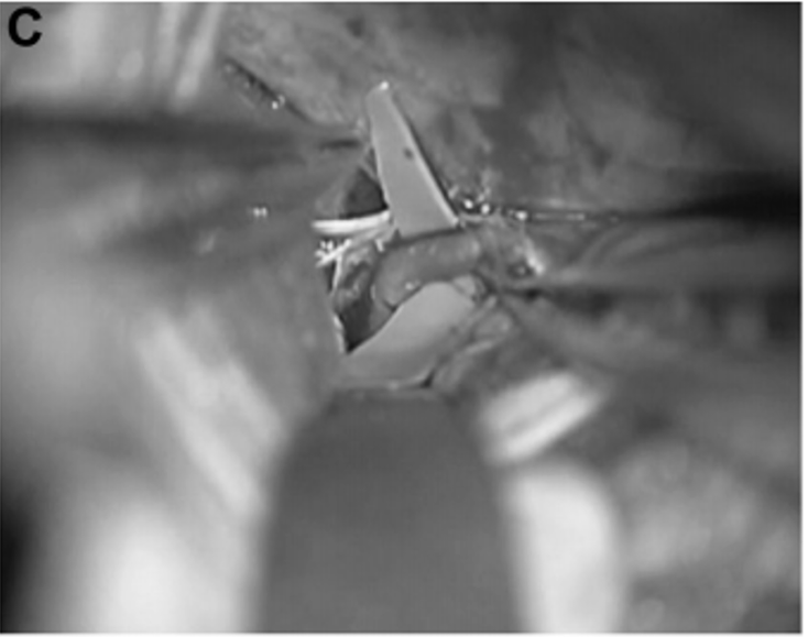 P3 段被选为搭桥血管位置(图 2C 和 2D)