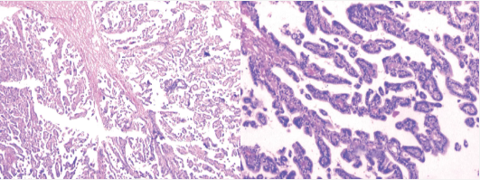 显微照片显示纤维血管核心的多个乳头状结构（左）、乳头状结构排列整齐的立方至柱状上皮细胞（右）