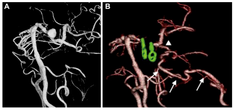 A，术前 3D-DSA 显示位于左侧 P1-P2 交界处动脉瘤。B，术后3D-CTA显示左侧 PCA 区血管穿支(箭头)和重建的 PTA 血管(箭头)血流通畅。