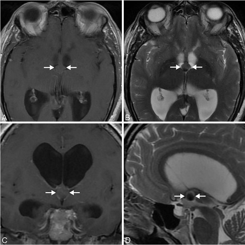 术前磁共振成像显示胶样囊肿，导致双侧脑室积水。