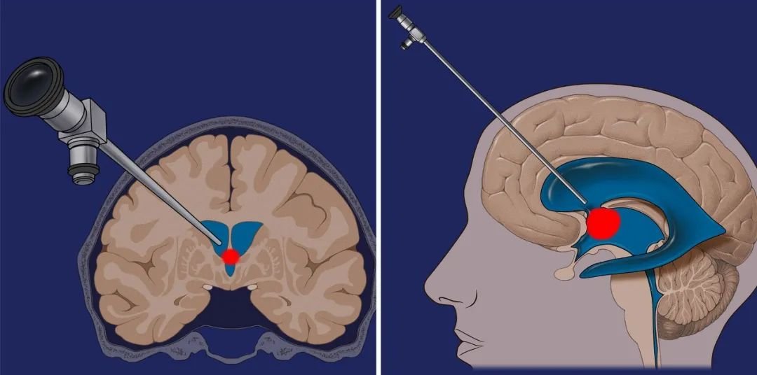 根据磁共振成像(MRI)规划手术入路，手术轨迹绕过尾状核头。