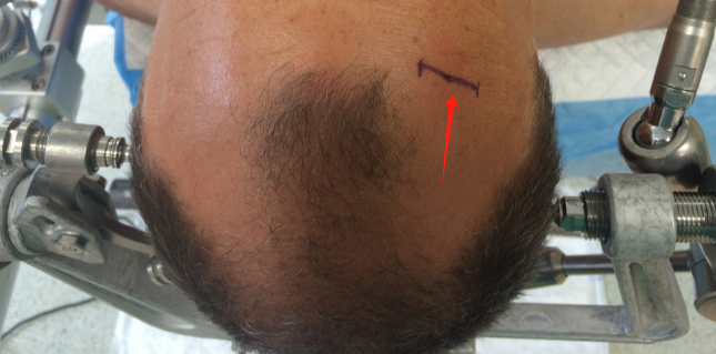 骨瓣位于冠状缝前 4-5 厘米，中线外侧4-5厘米处。出于美容原因，切口在发际线后或在秃顶患者中在前额皱纹处进行。做3厘米皮肤切口，并钻一个1厘米的骨孔。