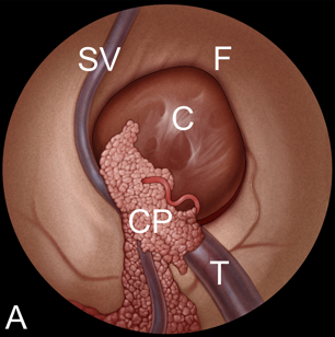 A：检查室间孔，可见胼胝体(F)、脉络丛(CP)、透明隔静脉(SV)和丘纹静脉(T)。室间孔被胶样囊肿(C)阻塞。